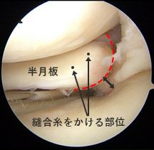 縫合前