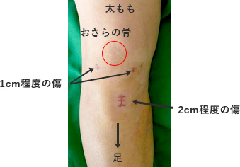抜糸後の外観
