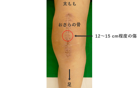 抜糸後の外観